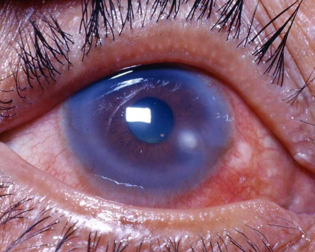 a picture of a red eye and a cloudy cornea