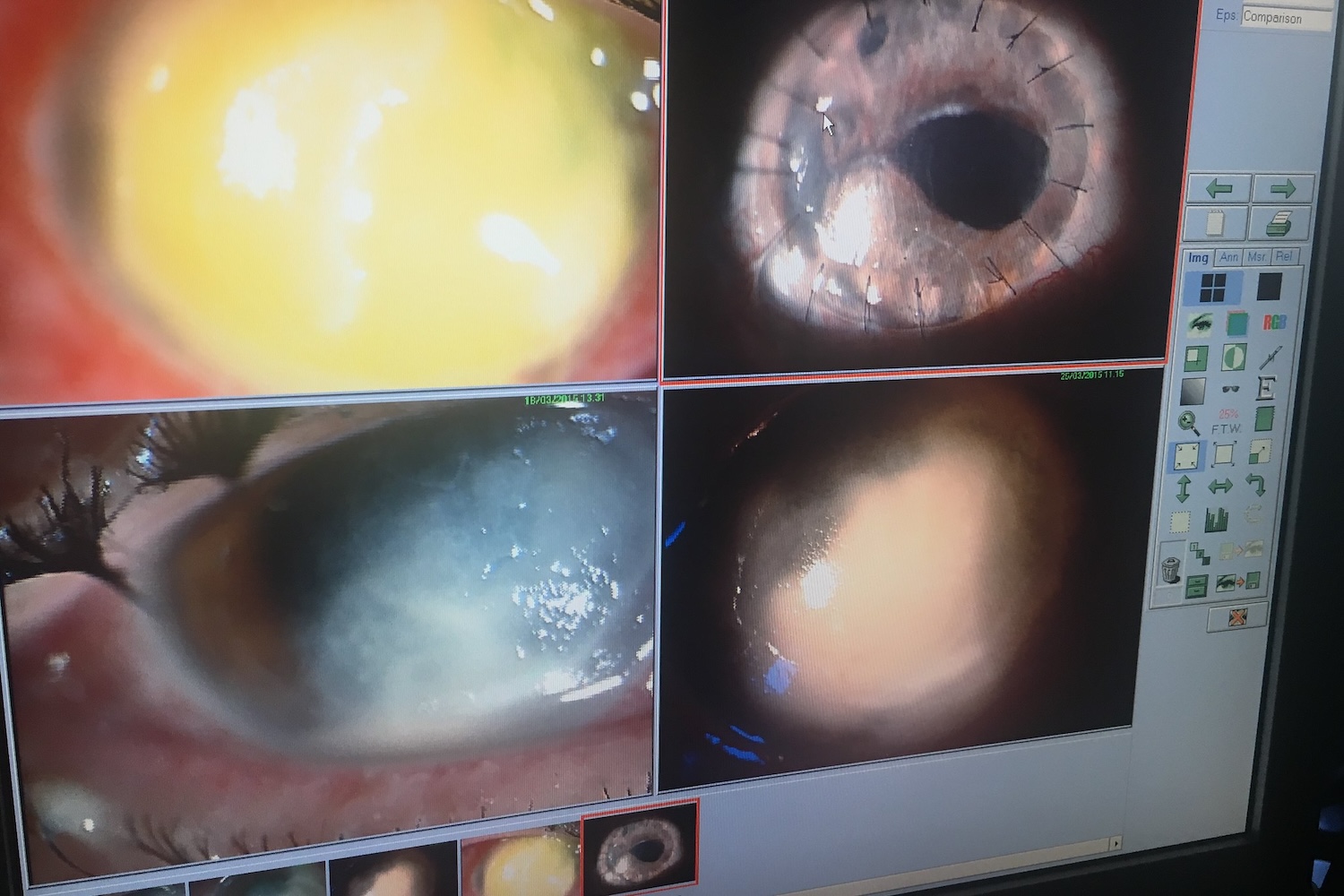  A computer screen with several corneal infections on it 
