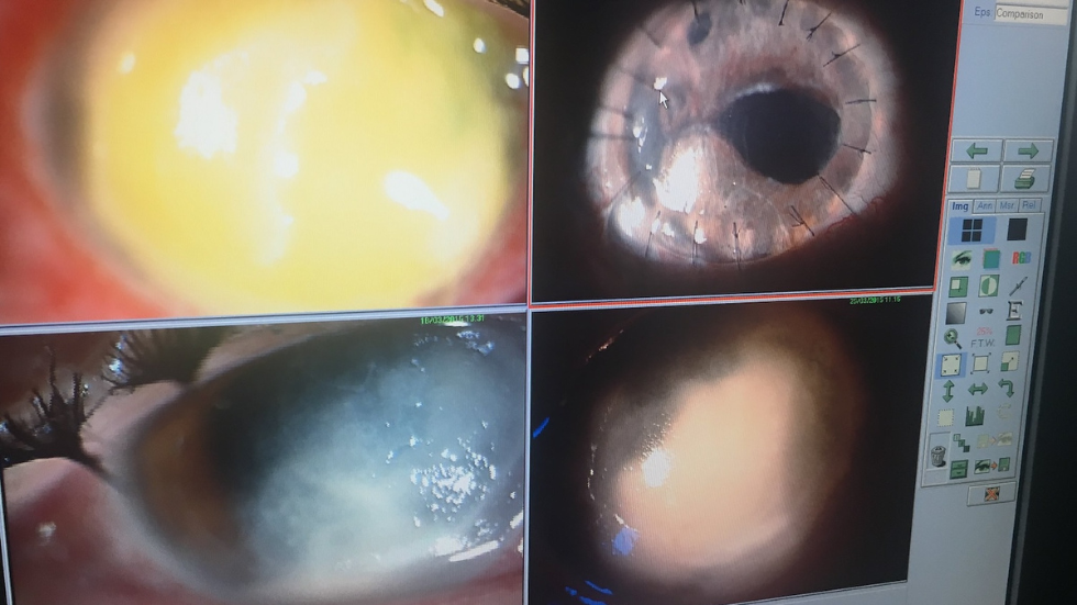 a computer screen with images of corneal impairments 