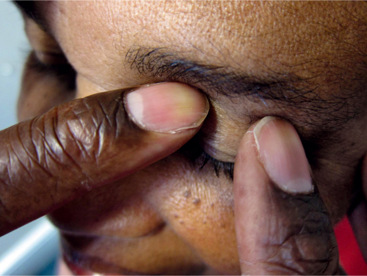 a person has their eye pressure tested by hand 