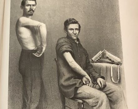 Lithograph illustration depicting two men showing their scars from resection operations after sustaining shot injuries.